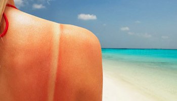 Лечение различных видов ожогов