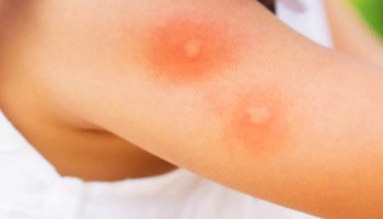 Защита от насекомых